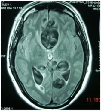 Figure-1: Multiple interhemispheric cysts